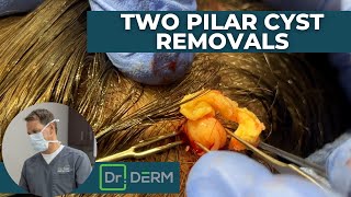 Two Pilar Cyst Removals  Dr Derm [upl. by Sira114]