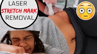 Laser Stretch Mark Removal INFO  MY PROCEDURE [upl. by Maribelle]