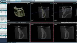 Axial Coronal and Sagittal view on VATECH Cone beam CT Picasso Trio [upl. by Poler]