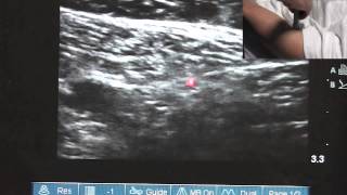 Ultrasound Guided Saphenous Nerve Block  SSRAUSAcom [upl. by Onitselec]