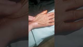 Scleroderma  Hard sclerotic skin  Sclerodactyly [upl. by Clapper]