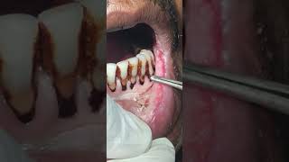 Leukoplakia lip excisionLaserCautery હોઠ માં રહેલ સફેદ ચાઠુ લેઝર કોટરીથી કેવી રીતે નીકળે જુઓ [upl. by Horsey]