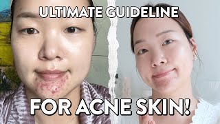 99 Overlook These Effective Acne Treatments – 2024 Guide [upl. by Wolfgram65]