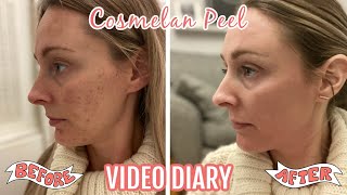 THE COSMELAN PEEL  MY FIRST CHEMICAL PEEL  DIARY FROM APPLICATION TO DAY 30 [upl. by Decca]