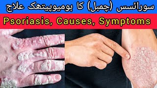 Psoriasis  Kharish  Chambal Ka Ilaj  Homeopathic medicine [upl. by Ahsena664]