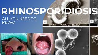 Rhinosporidiosis [upl. by Ludba]