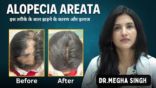 Symptoms and treatment of alopecia areata PRP Stem Cell Therapy Dr Megha [upl. by Netfa]