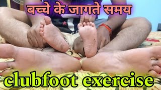 जब बच्चा जाग रहा हो तो clubfoot exercise ctev shoes कैसे पहनाएं😰😰  Dr Nargesh Agarwal [upl. by Safoelc231]