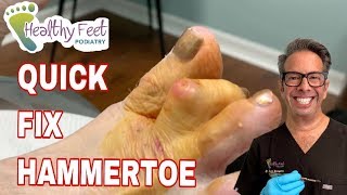 Quick Fix Hammertoe [upl. by Libbi254]