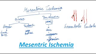 Mesenteric Ischemia  General Surgery Lecture  MBBS MS DNB [upl. by Ehtyde866]