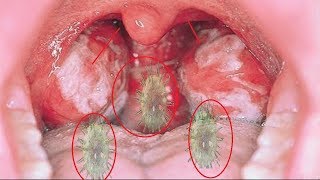 Home Remedies to Treat Mononucleosis  How to back Normal Throat [upl. by Ivatts]