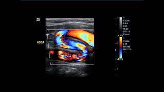 Extreme Kinking of the common carotid artery [upl. by Weihs907]