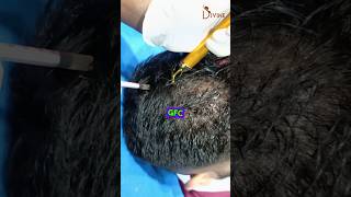 GFC Procedure for Hair Loss Treatment  GFC Treatment shortsfeed [upl. by Aeirdna]