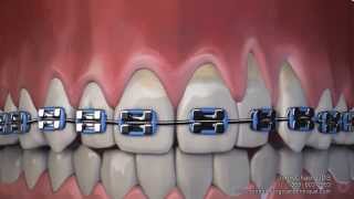 Gum Recession After Wearing Braces Can Now Be Treated Without Gum Grafting Surgery [upl. by Mitchell]