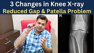 Knee x ray Knee Osteoarthritis Gap Reduced Chondromalacia patella Knee Joint Degeneration [upl. by Nerua]