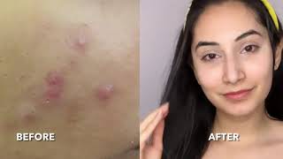 How to use Phitkari Alum to Treat Acne  Pigmentation and for Permanent Hair Removal  Life Hacks [upl. by Aleicarg237]