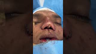 Columellar and Nasal Redo Reconstruction for Tessier Hyper teleroism plasticsurgery [upl. by Manlove]