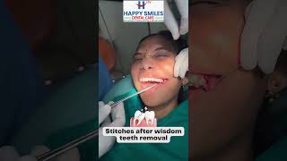 Stitches After Wisdom Teeth Removal  Happy Smiles Dental Care  shorts [upl. by Tootsie]