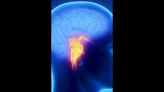 Brainstem syndromes stroke localization part 3 [upl. by Llevert]