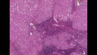 Histopathology LiverChronic active hepatitis cirrhosis [upl. by Aenal]