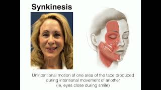 What is Facial Synkinesis [upl. by O'Connell]