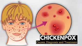 Chickenpox Causes Signs and Symptoms Diagnosis and Treatment [upl. by Annuaerb]