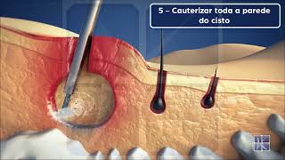 EPSIT Endoscopic Pilonidal Sinus Treatment  Tratamento Endoscópico do Cisto Pilonidal [upl. by Cavil]