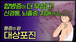 통증의 왕 대상포진 3일 안에 치료해야 통증과 후유증을 최소화 할 수 있습니다  부산mbc TV닥터인사이드 160911 방송 [upl. by Hcra355]