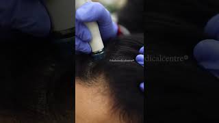 Keravive HydraFacial Treatment for Hair loss Hair Thinning or a Dry Itchy scalp  DMC Trichology [upl. by Yerocaj]