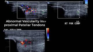 Knee Ultrasound basics  dynamic tests for anterior knee and ITB amp identifying collateral ligaments [upl. by Eelyma]