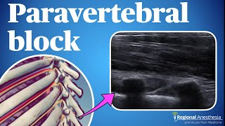 Ultrasound guided thoracic paravertebral block [upl. by Also]