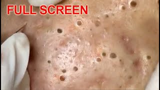 LARGE Blackheads Removal  Best Pimple Popping Videos [upl. by Enelime]