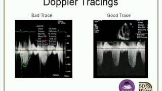 Optimizing Your Echo Images amp Doppler Evaluations webcast [upl. by Anneh]