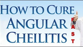 Treatment For Angular Cheilitis How to Treat Angular Stomatitis With Effective Treatment [upl. by Etyam]