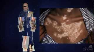 Understanding Vitiligo Misconception amp Myth [upl. by Oliviero434]