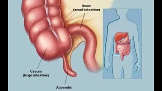 Important Facts for Surgical Anatomy of the Appendix [upl. by Laurence]