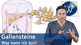 Gallensteine Was nun Typische Symptome Alles zur Entstehung amp Tipps zur natürlichen Entfernung [upl. by Zullo]