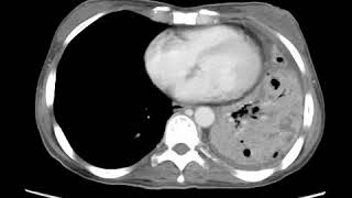 Necrotizing pneumonia Axial CECT Essential Radiology for Medical Students Interns and Residents [upl. by Goodson]