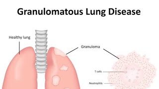 Granulomatous diseases of Lung Introduction [upl. by Enrahs961]