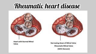 Community medicine  Rheumatic heart disease communitymedicine cardiovascularsystem [upl. by Vasilis]