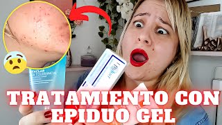 Epiduo anti acnéSerá que me funciona😱 [upl. by Vedetta]