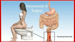 Prirodni Lek za Hemoroide Serbia [upl. by Akemaj184]