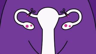 Brook Contraception  Sterilisation Animation [upl. by Bouley]