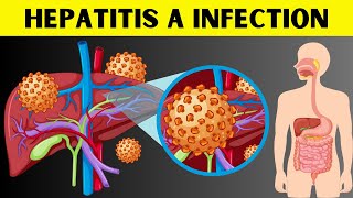 Hepatitis A Infection  Signs amp Symptoms Risk Factors Virology Diagnosis And Treatment [upl. by Nyletac782]