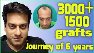 Hair Transplantation Result in 6 Years 4500 DHTFUE grafts NW 34 at 6 years Drs SethiBansal [upl. by Rochette]