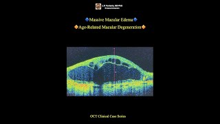 Massive Macular Edema AgeRelated Macular Degeneration [upl. by Nylisoj]