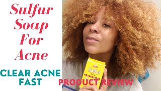 Acnestar Gel amp Acnestar soap Review amp results HOW TO GET RID OF ACNE FAST Pimples blackheads [upl. by Llenad821]