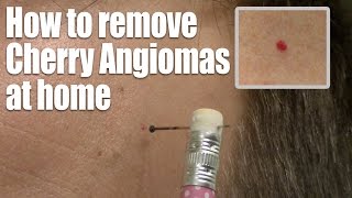 How to remove Red Skin Dots at home Quick amp Easy Cherry Angioma treatment [upl. by Marron]