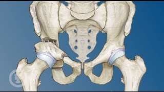 Hip Preservation Options for Young Adults [upl. by Neufer]