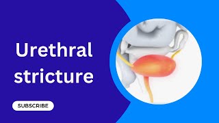 Urethral stricture Diseases of Urethra [upl. by Downey]